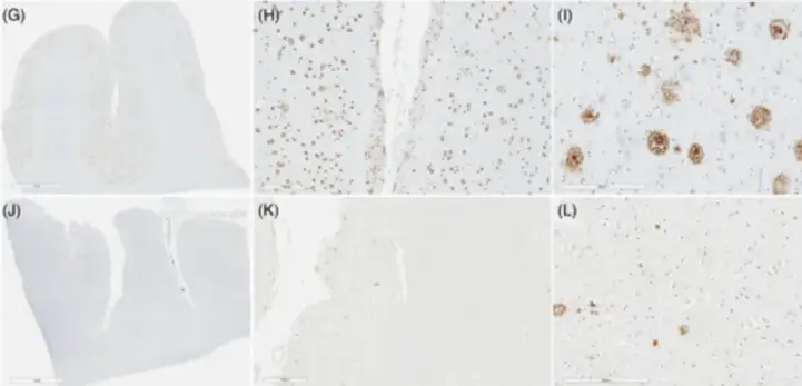 Верхний ряд — мозг с частыми альцгеймеровскими бляшками (коричневые пятна), нижний — мозг почти без них. Источник: Clarke et al., Alzheimer's & Dementia, 2025.