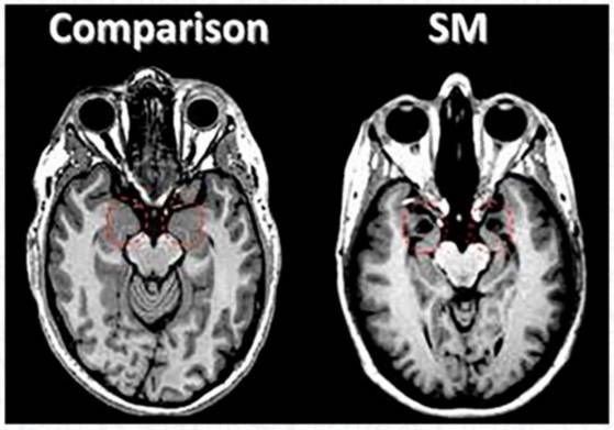 Неинвазивная амигдатотомия на сканах мозга. Красным обведена зона миндалевидного тела, которая атрофируется у пациентов с болезнью Урбаха — Вите. Слева — норма, справа — пациентка С.М.