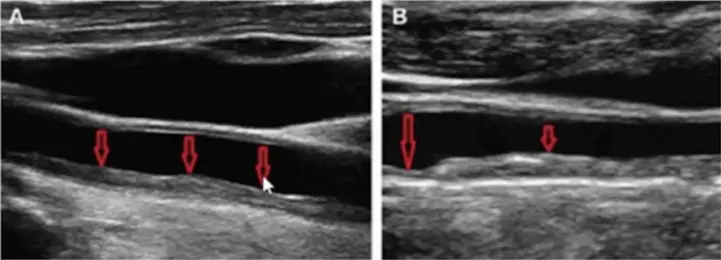 Сосуд с нормальной толщиной КИМ (А) и сосуд с утолщением (B)